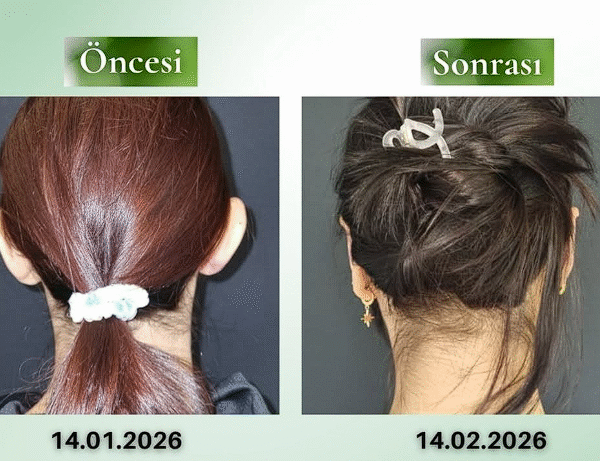 Kepçe Kulak Ameliyatı ile Doğal ve Estetik Kulak Görünümü: Bilgilendirme “Her cerrahi veya girişimsel işlemde sonuçlar kişiden kişiye değişiklik gösterebilir. İşlem öncesinde hekiminizden detaylı görüş almanız önerilir.” Görsel: Gerçek Hastadır. Hastanın izni mevcuttur.