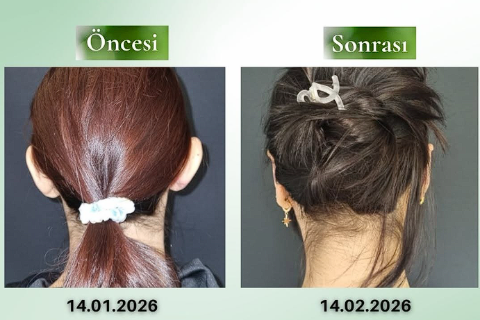 Kepçe Kulak Ameliyatı ile Doğal ve Estetik Kulak Görünümü: Bilgilendirme “Her cerrahi veya girişimsel işlemde sonuçlar kişiden kişiye değişiklik gösterebilir. İşlem öncesinde hekiminizden detaylı görüş almanız önerilir.” Görsel: Gerçek Hastadır. Hastanın izni mevcuttur.